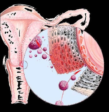 Virut HPV gây bệnh sùi mào gà