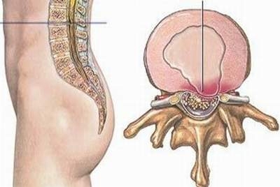  Thoát vị đĩa đệm gây đau thần kinh tọa